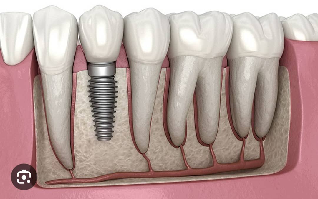 Dental Implants